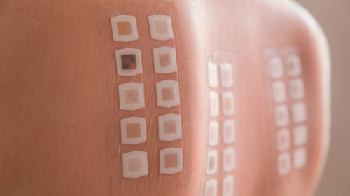 Patch test: como funciona?