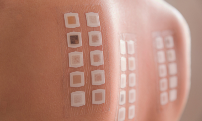 Patch test: como funciona?