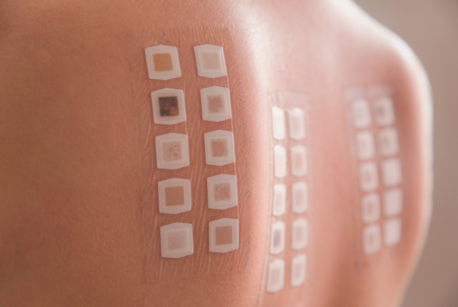 Patch test: como funciona?